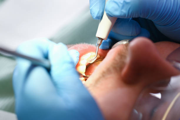 Best Emergency Root Canal Treatment in Timberwood Park, TX