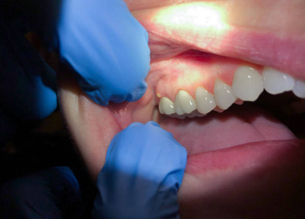 Best Emergency Gum Treatment in Timberwood Park, TX