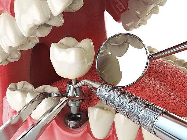 Best Emergency Root Canal Treatment in Timberwood Park, TX