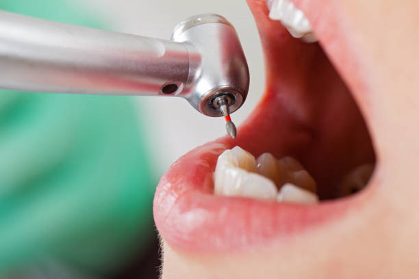 Best Emergency Dental Care for Broken or Chipped Teeth in Timberwood Park, TX
